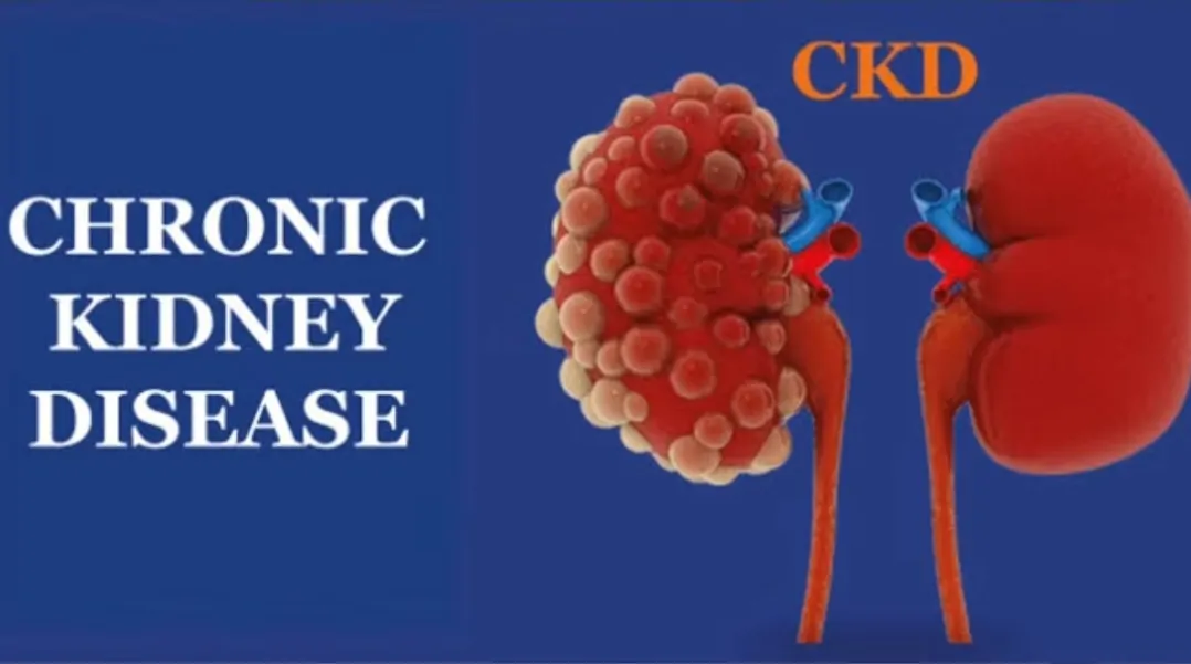 किडनी (Kidney) की बीमारी (CKD) में रीज और परिवार की ७ आम गलतियाँ By: Dr. A. K. Gupta