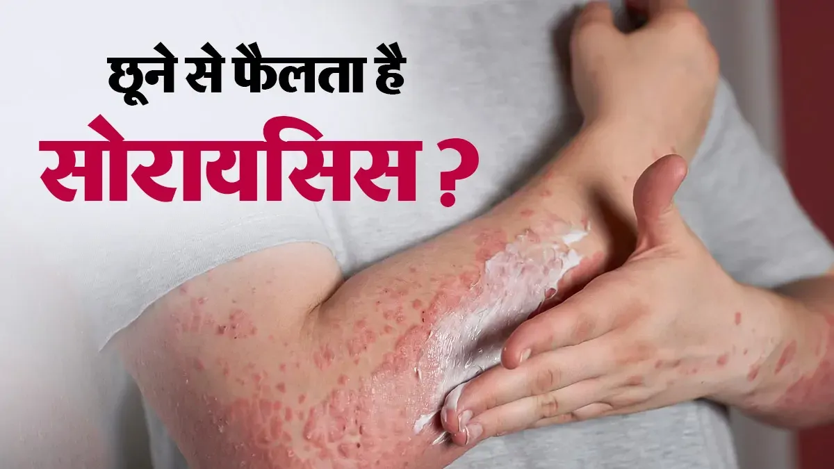 World Psoriasis Day: क्या सोरायसिस छूने से फैलता है? मरीज के साथ खाना खाने और रहने पर जानें डॉक्टर की राय